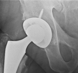 My Hip Replacement